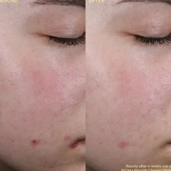 Blemish Clearing Paste - Anti-imperfektionspasta