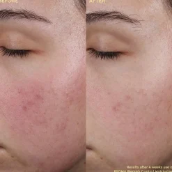 Blemish Control Moisturizer - Fugtighedscreme mod urenheder