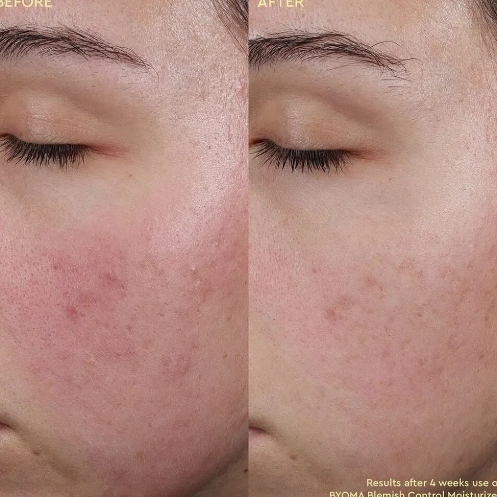 Blemish Control Moisturizer - Fugtighedscreme mod urenheder